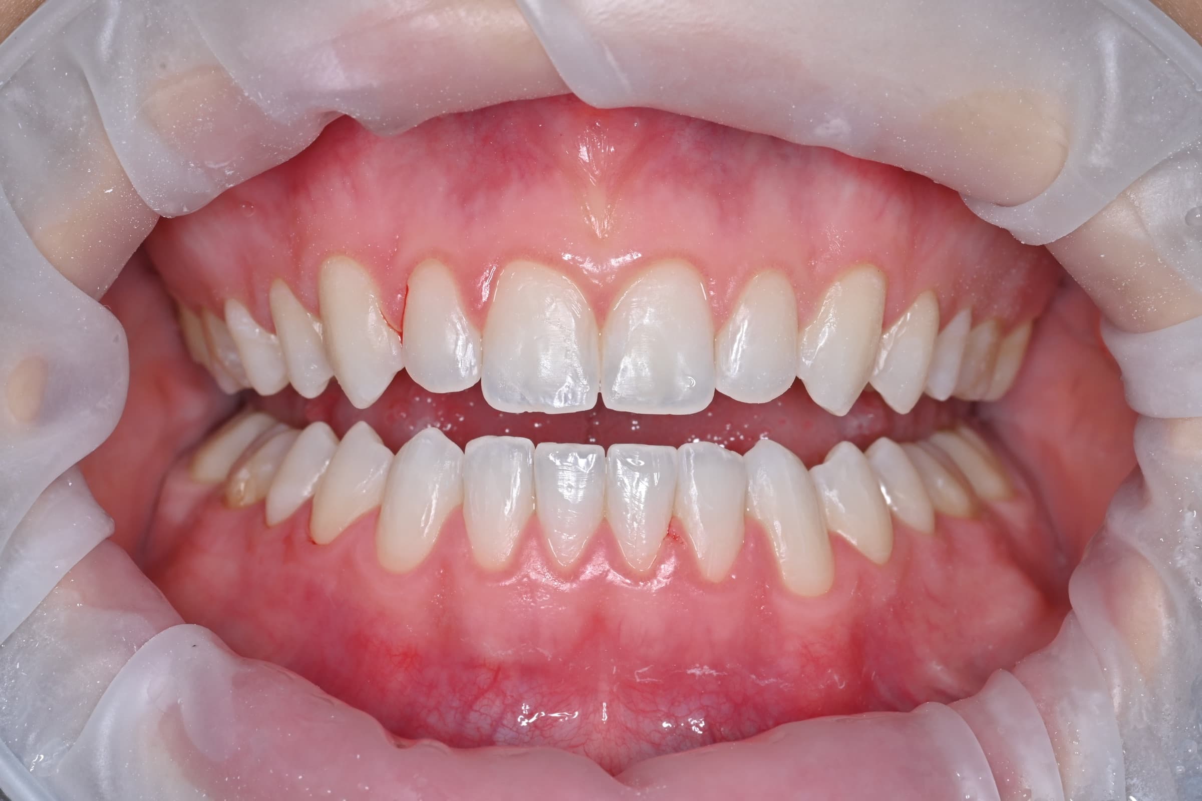 Orthodontie adulte, cas 1, résultat