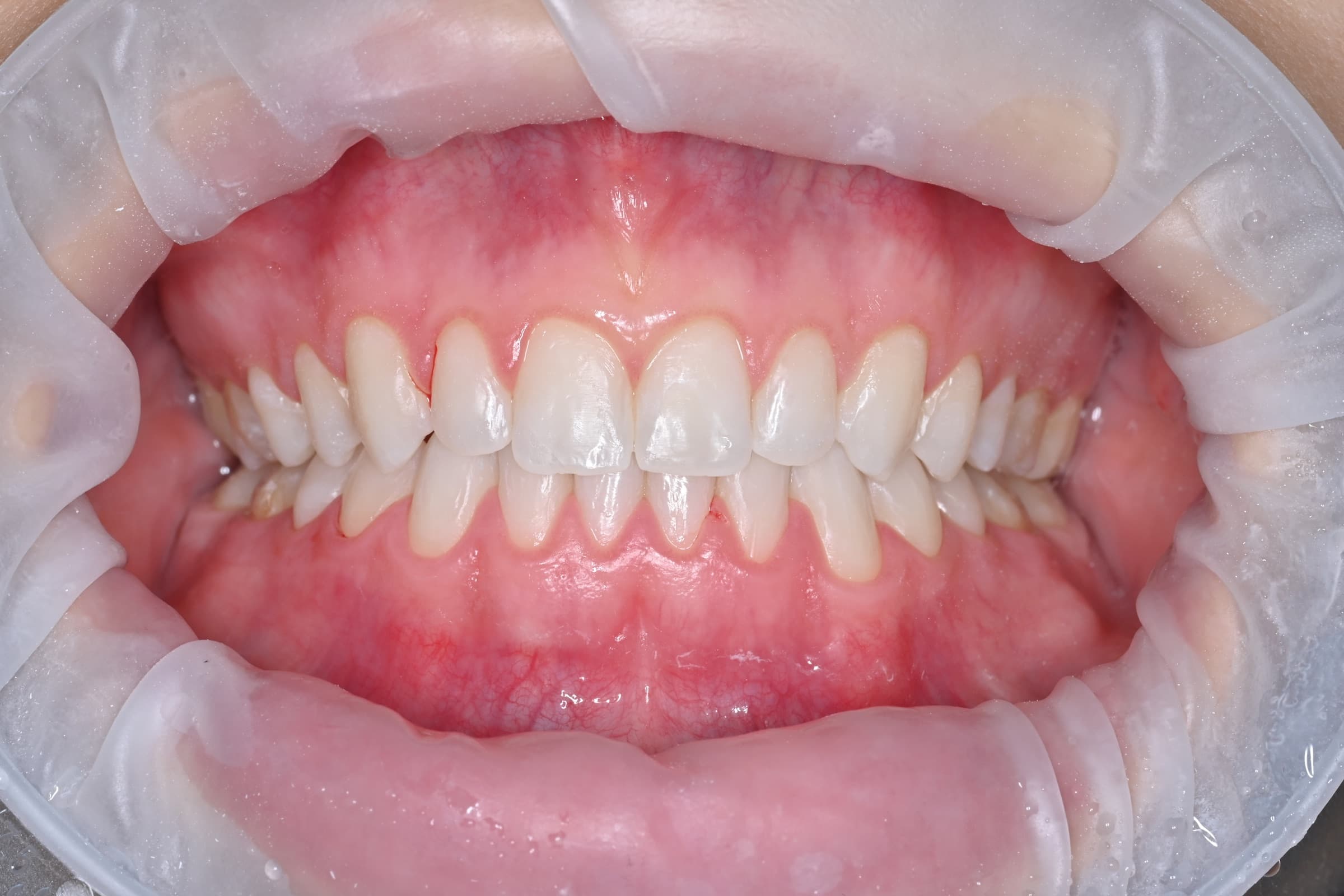 Orthodontie adulte, cas 1, état initial