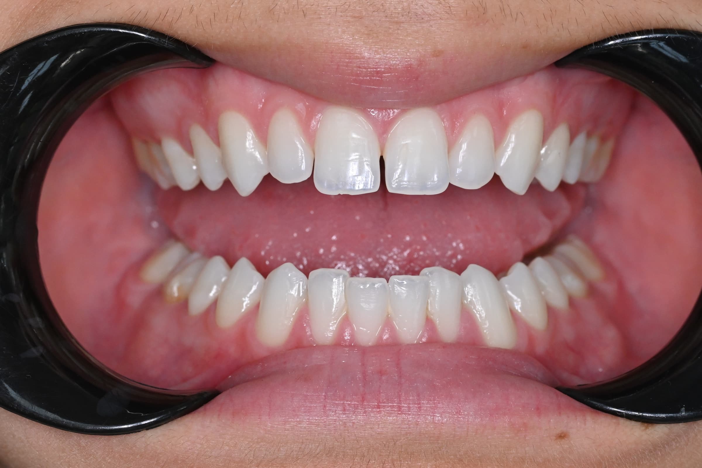 Orthodontie adulte, cas 2, résultat