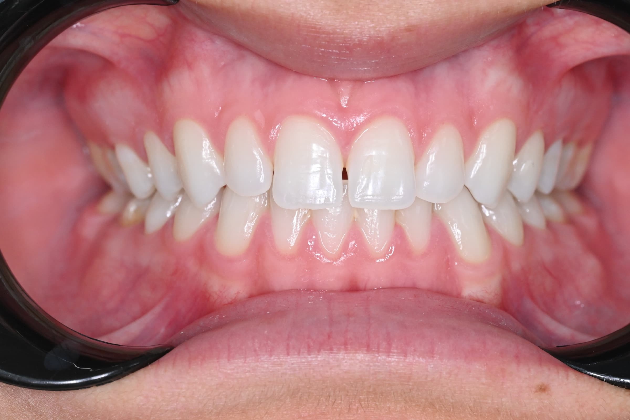 Orthodontie adulte, cas 2, état initial